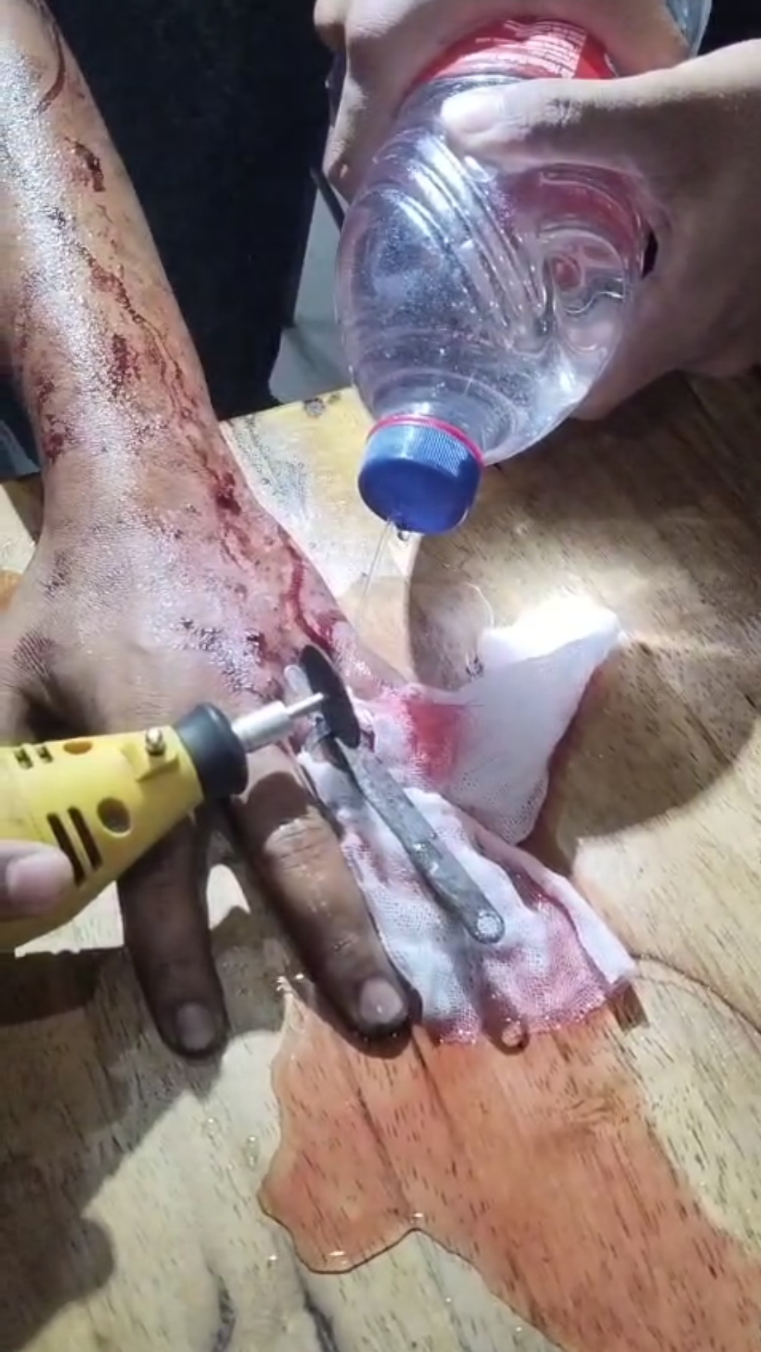 Penanganan Cincin